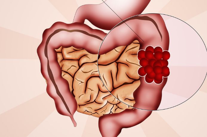 結(jié)直腸癌 (18).jpg