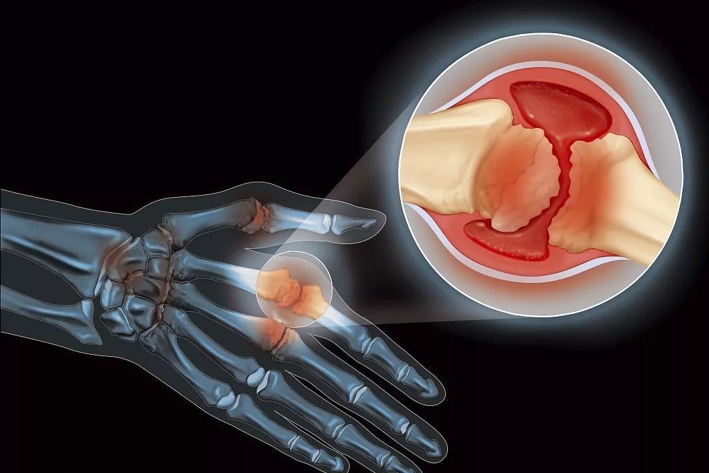 1598582350146431.jpg 痛風(fēng) (2).jpg