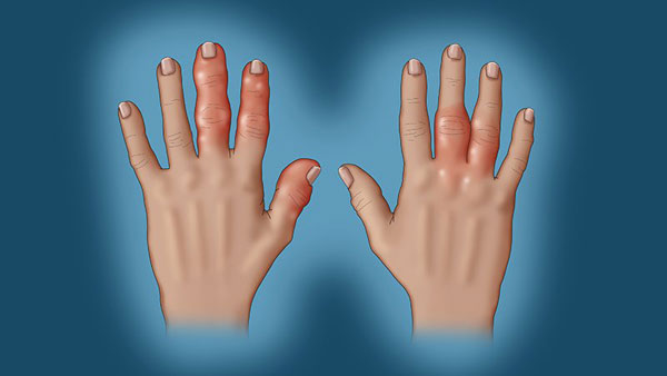 1598945058290515.jpg ps_191217_psoriatic_arthritis_800x450.jpg