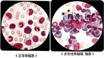 多發(fā)性骨髓瘤 (5).jpg