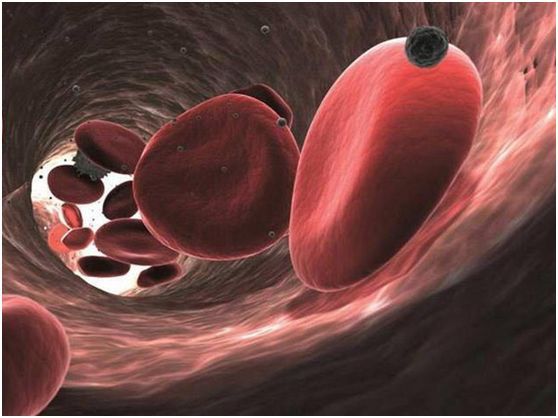 多發(fā)性骨髓瘤 (2).jpg