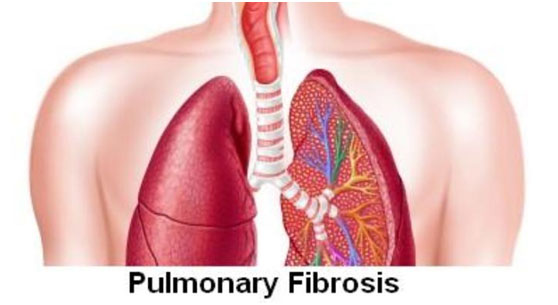 肺纖維化，蜂窩肺，百草枯肺