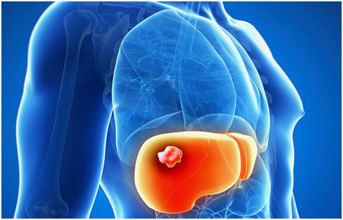 肝癌