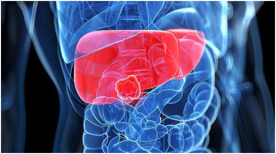 肝癌,轉(zhuǎn)移性肝癌