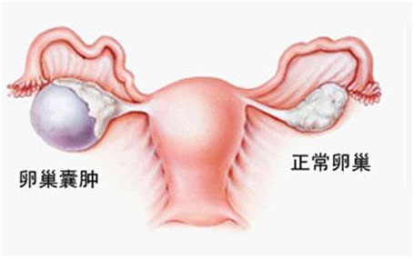 卵巢囊腫