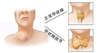 甲狀腺結(jié)節(jié)
