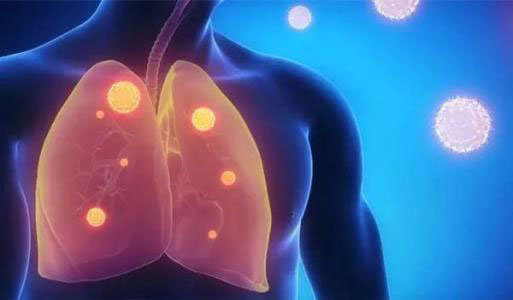 肺部結(jié)節(jié)