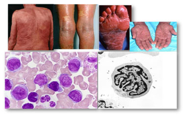 塞澤里綜合征(Sezary syndrome, SS)