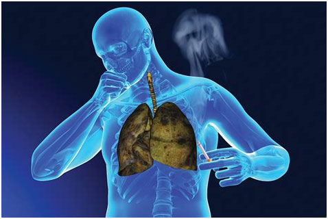 小細(xì)胞肺癌