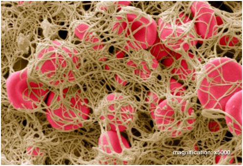 什么導(dǎo)致深靜脈血栓