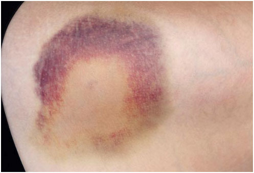 血液稀釋劑的副作用