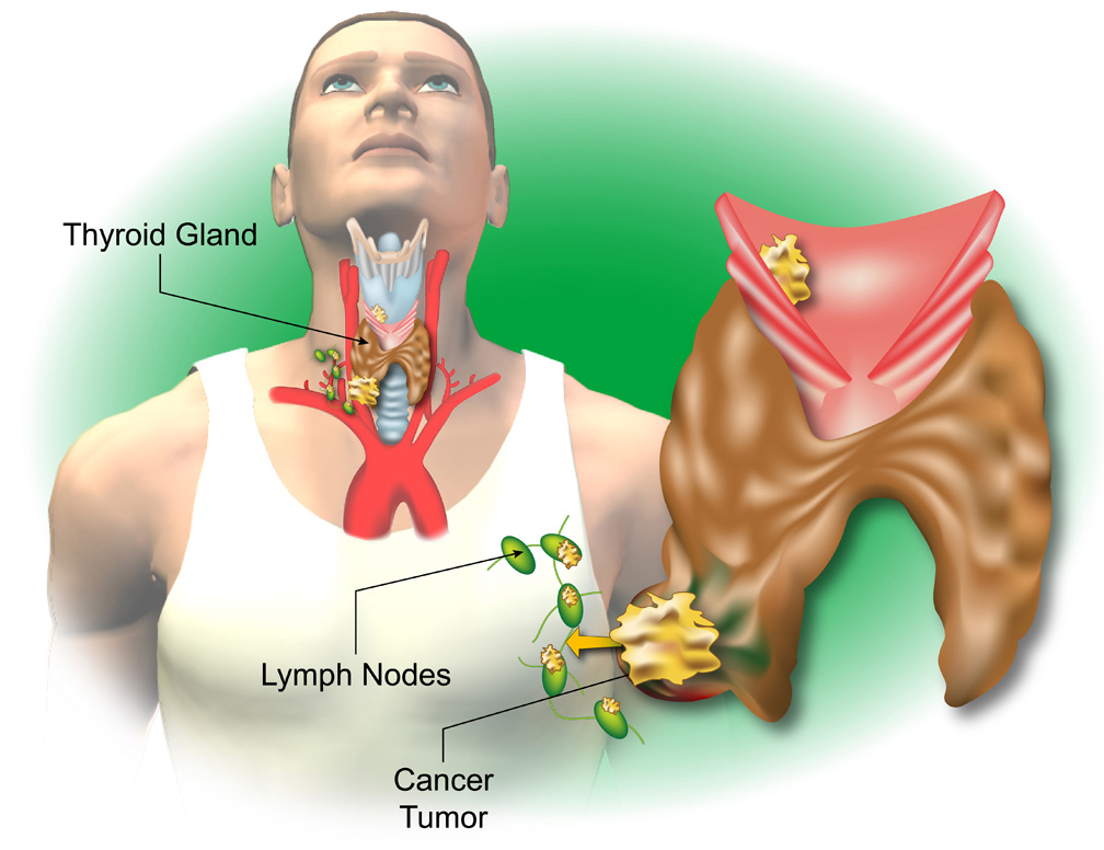 1602298697680776.jpg 甲狀腺癌 (16).jpg