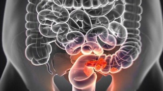 1604890633791278.jpg 腸癌2.jpg