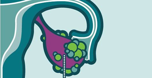 1605148805738746.jpg 卵巢癌 (11).jpg