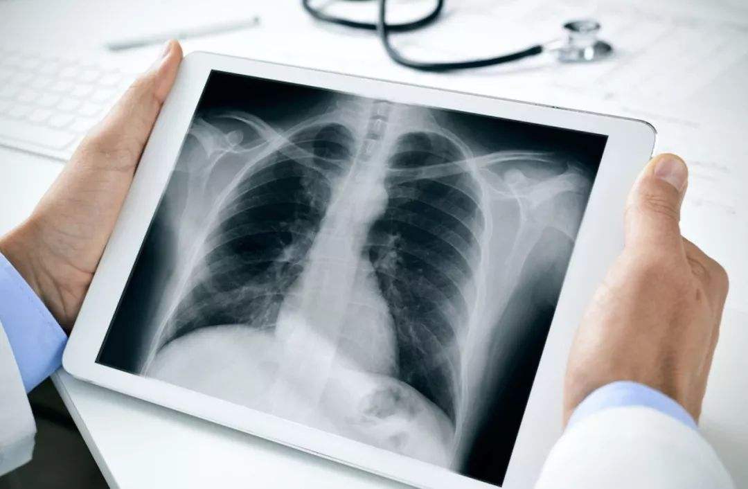 1606100584515686.jpg 肺癌15.jpg