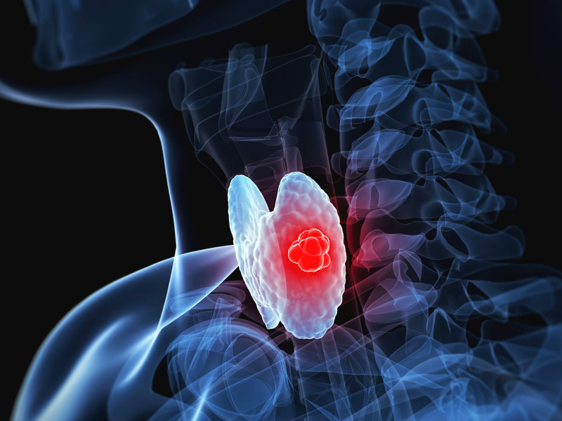 甲狀腺癌 (6).jpg