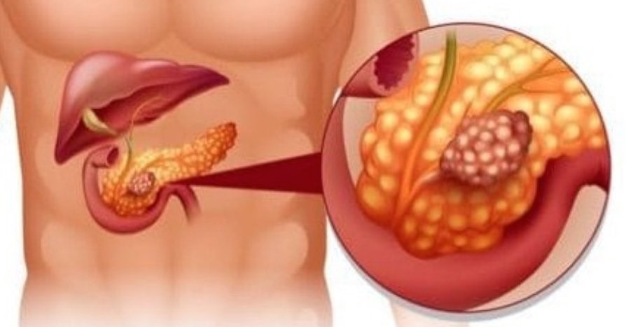 1606447198537215.jpg 胰腺癌 (5).jpg