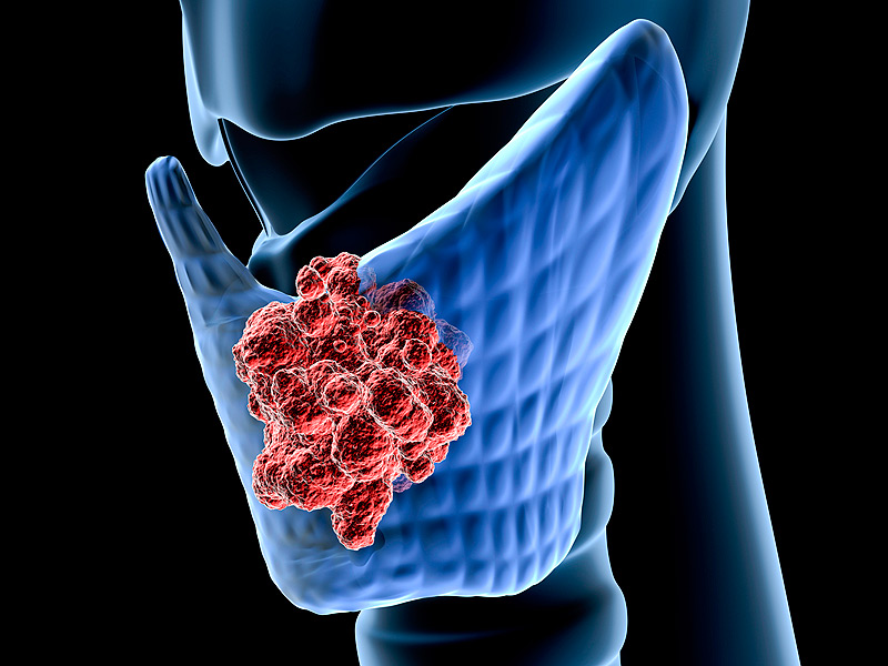 甲狀腺癌 (4).jpg