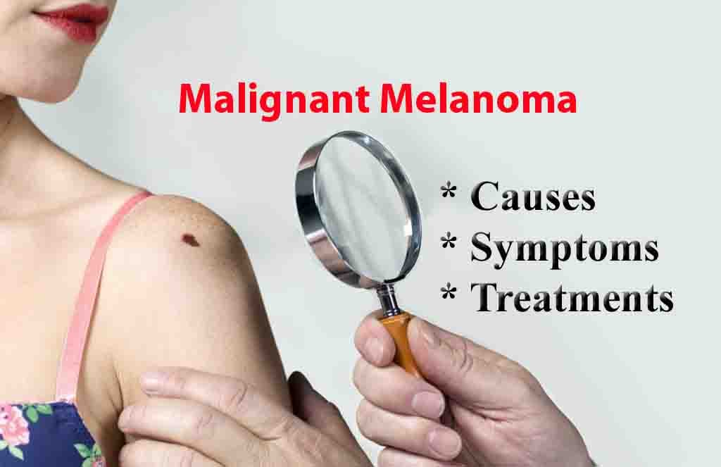 黑色素瘤 (3).jpg