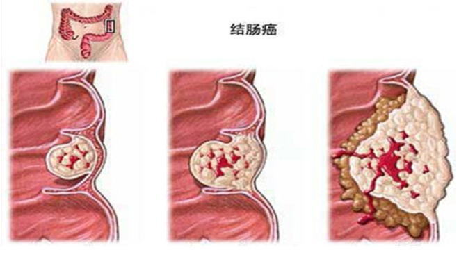 結(jié)腸癌 (1).jpg