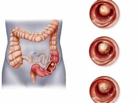 結(jié)腸癌 (2).jpg