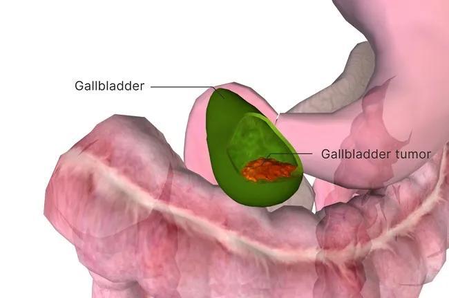 How-prevalent-is-gallbladder-cancer.jpg
