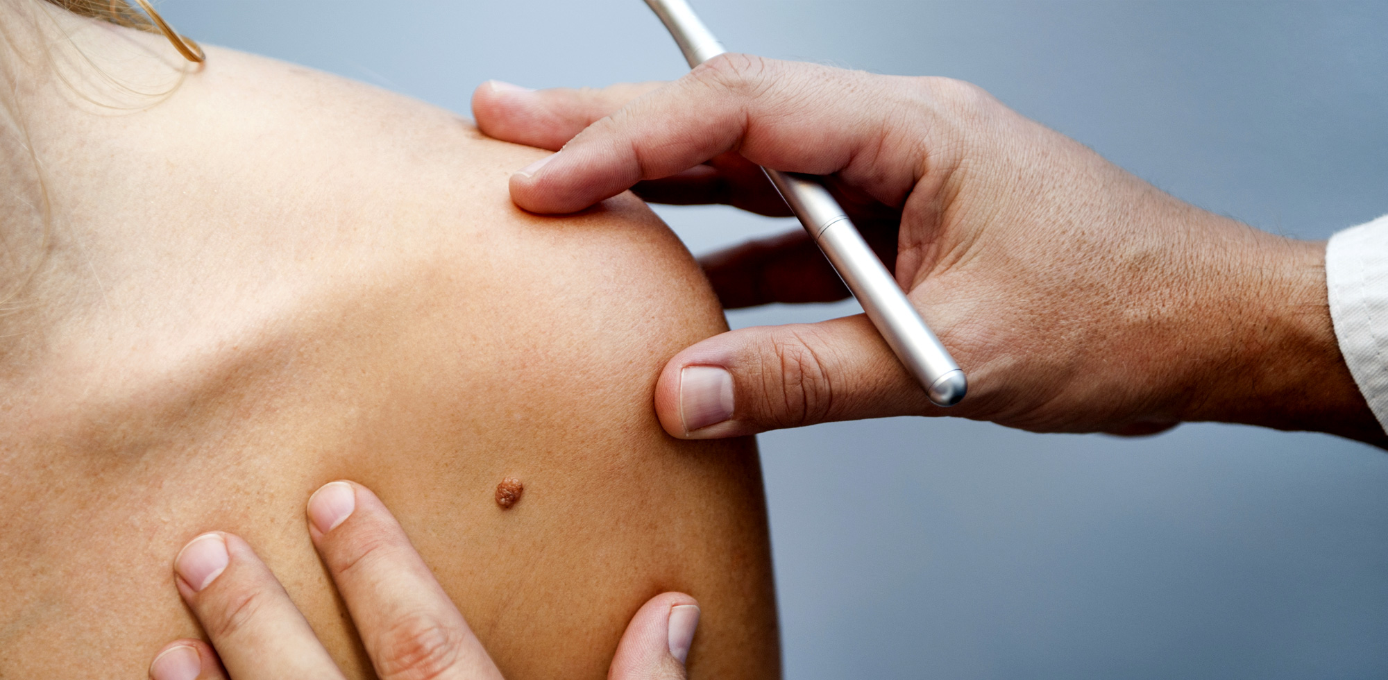 1636510657717400.jpg 黑色素瘤 (16).jpg